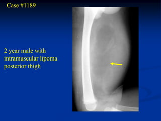 Case #1189




2 year male with
intramuscular lipoma
posterior thigh
 