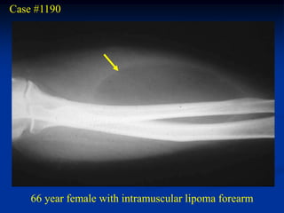 Case #1190




    66 year female with intramuscular lipoma forearm
 