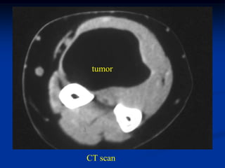 tumor




CT scan
 