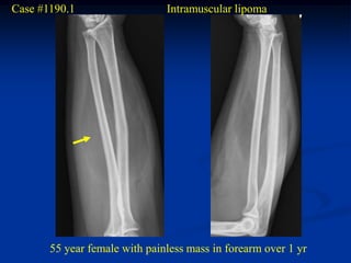 Case #1190.1                   Intramuscular lipoma




       55 year female with painless mass in forearm over 1 yr
 