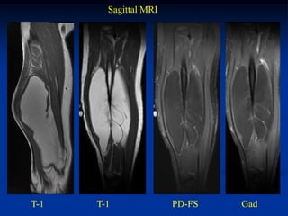 Sagittal MRI




T-1   T-1              PD-FS   Gad
 