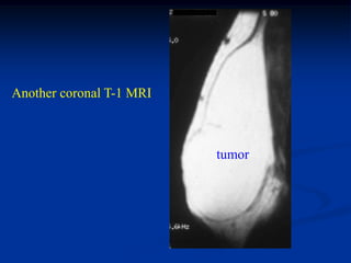 Another coronal T-1 MRI



                          tumor
 