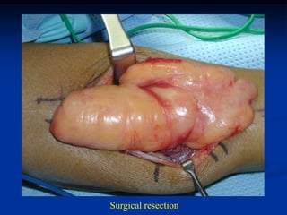 Surgical resection
 
