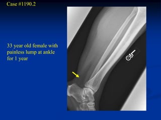 Case #1190.2




33 year old female with
painless lump at ankle
for 1 year
 