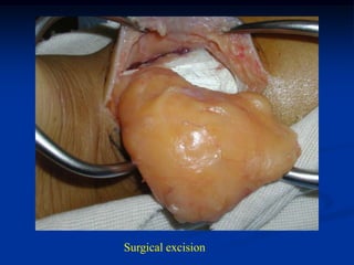 Surgical excision
 