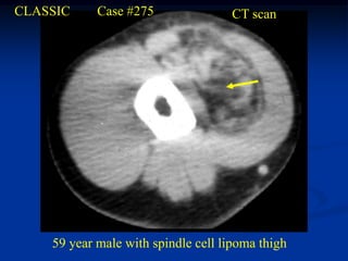 CLASSIC     Case #275               CT scan




    59 year male with spindle cell lipoma thigh
 