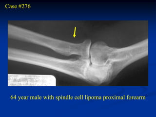 Case #276




 64 year male with spindle cell lipoma proximal forearm
 
