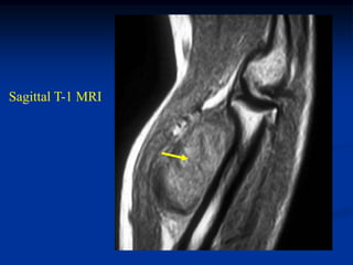 Sagittal T-1 MRI
 