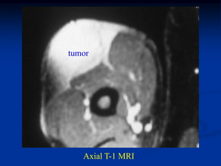 tumor




   Axial T-1 MRI
 