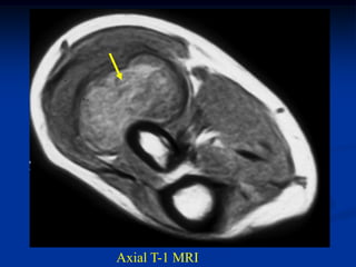 Axial T-1 MRI
 