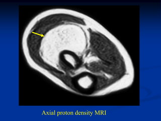 Axial proton density MRI
 