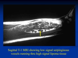 Sagittal T-1 MRI showing low signal serpinginous
  vessels running thru high signal lipoma tissue
 