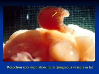 Resection specimen showing serpinginous vessels in fat
 