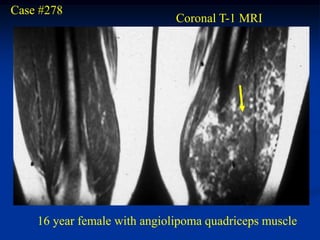 Case #278
                              Coronal T-1 MRI




    16 year female with angiolipoma quadriceps muscle
 