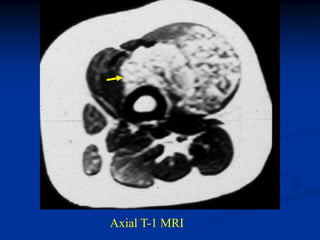 Axial T-1 MRI
 