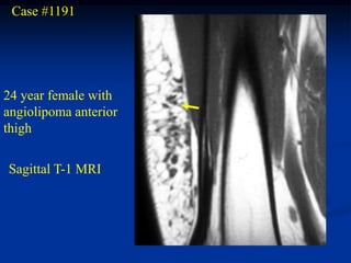 Case #1191




24 year female with
angiolipoma anterior
thigh

Sagittal T-1 MRI
 