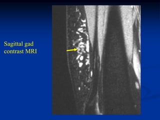 Sagittal gad
contrast MRI
 