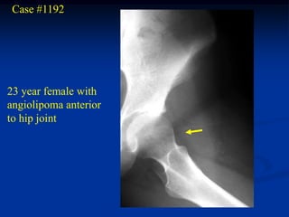 Case #1192




23 year female with
angiolipoma anterior
to hip joint
 