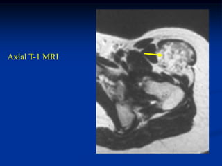 Axial T-1 MRI
 