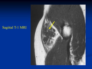 Sagittal T-1 MRI
 