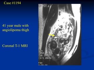 Case #1194




41 year male with
angiolipoma thigh



Coronal T-1 MRI
 