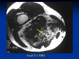 Axial T-1 MRI
 