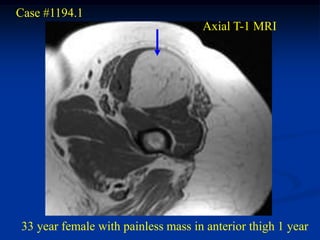 Case #1194.1
                                    Axial T-1 MRI




33 year female with painless mass in anterior thigh 1 year
 