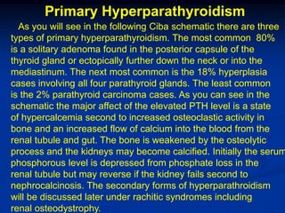 Primary Hyperparathyroidism
  As you will see in the following Ciba schematic there are three
types of primary hyperparathyroidism. The most common 80%
is a solitary adenoma found in the posterior capsule of the
thyroid gland or ectopically further down the neck or into the
mediastinum. The next most common is the 18% hyperplasia
cases involving all four parathyroid glands. The least common
is the 2% parathyroid carcinoma cases. As you can see in the
schematic the major affect of the elevated PTH level is a state
of hypercalcemia second to increased osteoclastic activity in
bone and an increased flow of calcium into the blood from the
renal tubule and gut. The bone is weakened by the osteolytic
process and the kidneys may become calcified. Initially the serum
phosphorous level is depressed from phosphate loss in the
renal tubule but may reverse if the kidney fails second to
nephrocalcinosis. The secondary forms of hyperparathroidism
will be discussed later under rachitic syndromes including
renal osteodystrophy.
 