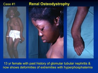 Case #1           Renal Osteodystrophy




 13 yr female with past history of glomular tubular nephritis &
now shows deformities of extremities with hyperphosphatemia
 