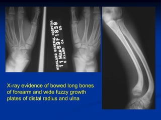 X-ray evidence of bowed long bones
of forearm and wide fuzzy growth
plates of distal radius and ulna
 