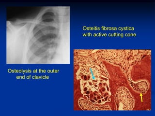 Osteitis fibrosa cystica
                          with active cutting cone




Osteolysis at the outer
   end of clavicle
 