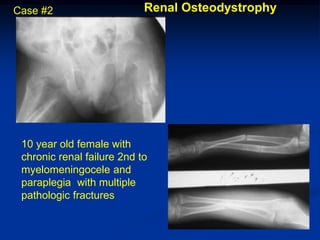 Case #2                     Renal Osteodystrophy




 10 year old female with
 chronic renal failure 2nd to
 myelomeningocele and
 paraplegia with multiple
 pathologic fractures
 