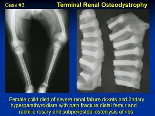 Case #3               Terminal Renal Osteodystrophy




 Female child died of severe renal failure rickets and 2ndary
 hyperparathyroidism with path fracture distal femur and
    rachitic rosary and subperiosteal osteolysis of ribs
 