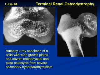 Case #4           Terminal Renal Osteodystrophy




Autopsy x-ray specimen of a
child with wide growth plates
and severe metaphyseal end
plate osteolysis from severe
secondary hyperparathyroidism
 