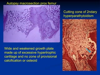 Autopsy macrosection prox femur

                                       Cutting cone of 2ndary
                                       hyperparathytoidism




Wide and weakened growth plate
made up of excessive hypertrophic
cartilage and no zone of provisional
calcification or osteoid
 