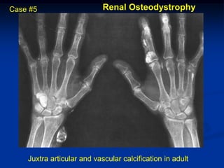 Case #5                     Renal Osteodystrophy




    Juxtra articular and vascular calcification in adult
 