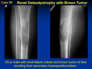 Case #6   Renal Osteodystrophy with Brown Tumor




  63 yr male with renal failure rickets and brown tumor of tibia
        resulting from secondary hyperparathyroidism
 
