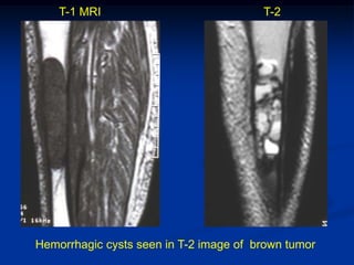 T-1 MRI                             T-2




Hemorrhagic cysts seen in T-2 image of brown tumor
 