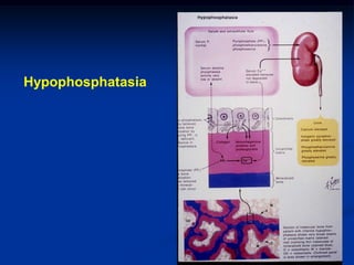 Hypophosphatasia
 