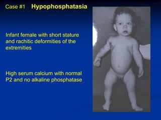 Case #1    Hypophosphatasia



Infant female with short stature
and rachitic deformities of the
extremities



High serum calcium with normal
P2 and no alkaline phosphatase
 
