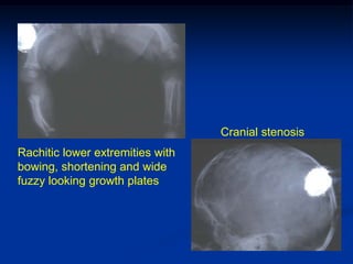 Cranial stenosis
Rachitic lower extremities with
bowing, shortening and wide
fuzzy looking growth plates
 