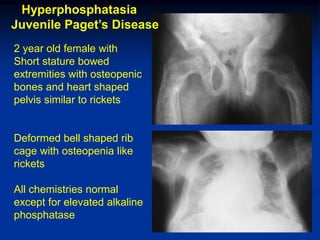 Hyperphosphatasia
Juvenile Paget’s Disease
2 year old female with
Short stature bowed
extremities with osteopenic
bones and heart shaped
pelvis similar to rickets


Deformed bell shaped rib
cage with osteopenia like
rickets

All chemistries normal
except for elevated alkaline
phosphatase
 