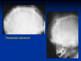 Thickened calvarium
 