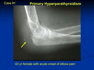 Case #1         Primary Hyperparathyroidism




      43 yr female with acute onset of elbow pain
 