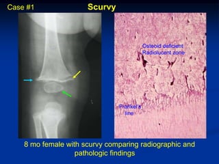 Case #1               Scurvy



                                           Osteoid deficient
                                           Radiolucent zone




                               Frankel’s
                                 line




    8 mo female with scurvy comparing radiographic and
                   pathologic findings
 