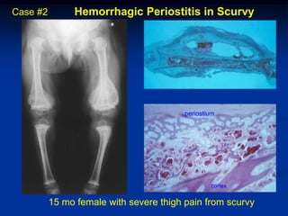 Case #2        Hemorrhagic Periostitis in Scurvy




                                         periostium




                                                 cortex


          15 mo female with severe thigh pain from scurvy
 