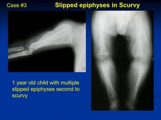 Case #3             Slipped epiphyses in Scurvy




 1 year old child with multiple
 slipped epiphyses second to
 scurvy
 