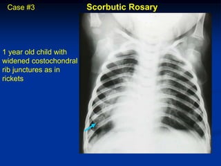Case #3                Scorbutic Rosary




1 year old child with
widened costochondral
rib junctures as in
rickets
 