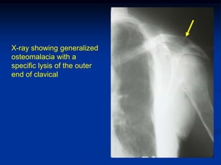 X-ray showing generalized
osteomalacia with a
specific lysis of the outer
end of clavical
 
