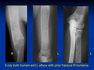 R                                L                        L


X-ray both humeri and L elbow with prior fracture R humerus
 
